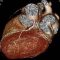 How stem cells work to repair raptured heart tissues, increase blood flow