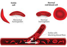 Gene therapy gives researchers ammunition needed to find cure for sickle-cell disease at its molecular roots