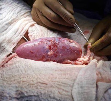 Surgeons successfully transplant pig kidney to human as pig-to-human organ switch come a step closer