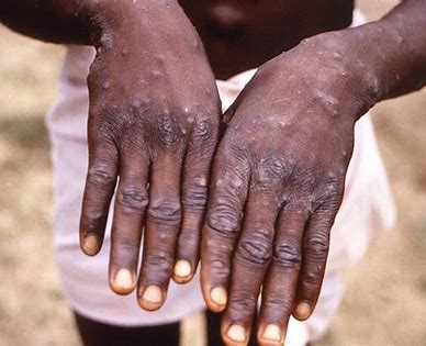 Stereotyping? Strain of monkeypox virus detected in Canada, US and Europe in gays, lesbians…then linked to Africa!