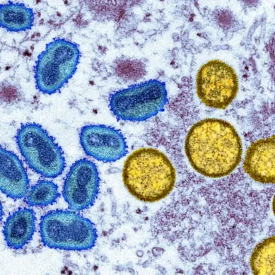 Current monkeypox spike in US and Europe termed unusual as the patients had no recent travel abroad
