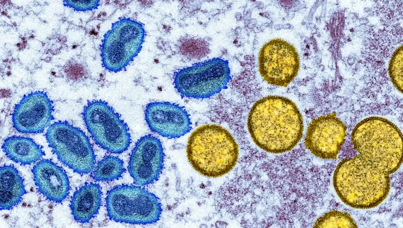 Current monkeypox spike in US and Europe termed unusual as the patients had no recent travel abroad