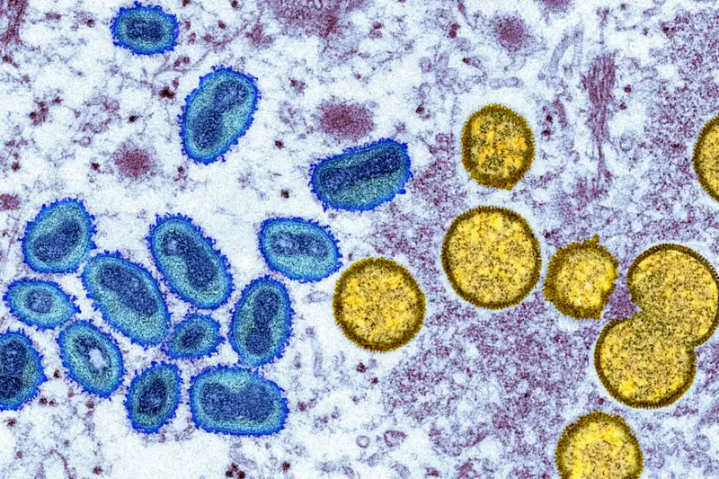 Current monkeypox spike in US and Europe termed unusual as the patients had no recent travel abroad