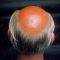 New report links baldness and excessive male hair loss to high consumption of sugary liquids