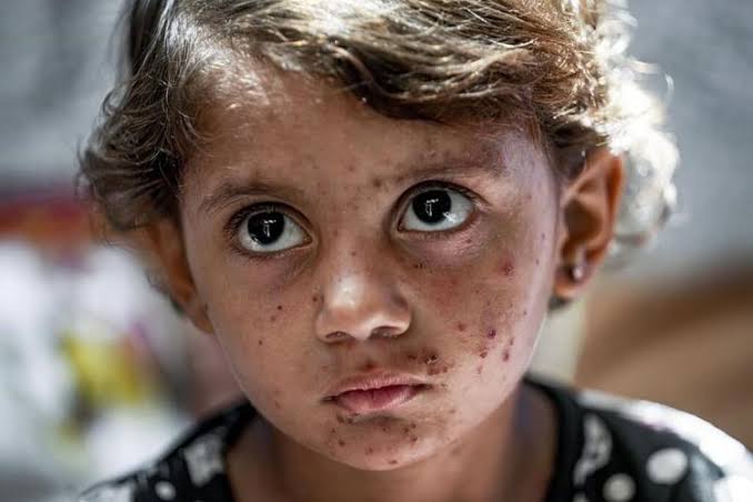 Sewage swamps and dilapidated tents typify lives of displaced Gazans plagued by skin diseases